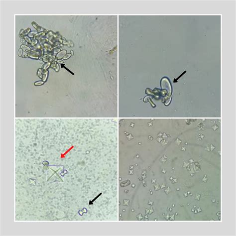 รายการ 91+ ภาพ Calcium Oxalate ในปัสสาวะ ครบถ้วน