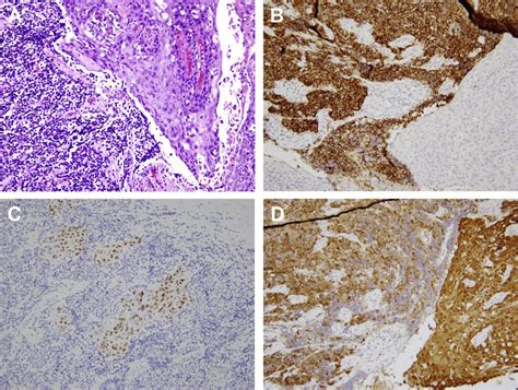 HPV-positive oropharyngeal carcinoma shows both small cell and squamous... | Download Scientific ...