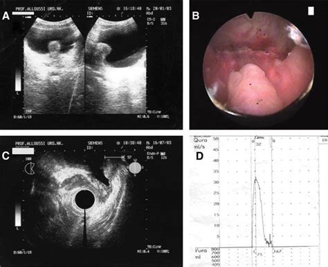 (A) Preoperative evaluation of the prostate by transrectal ultrasound,... | Download Scientific ...