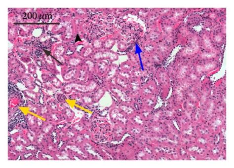 Hypertensive Nephrosclerosis Kidney Histology, 40% OFF