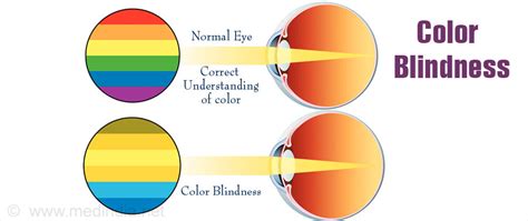 Color Blindness - Types, Causes, Symptoms, Diagnosis & Treatment