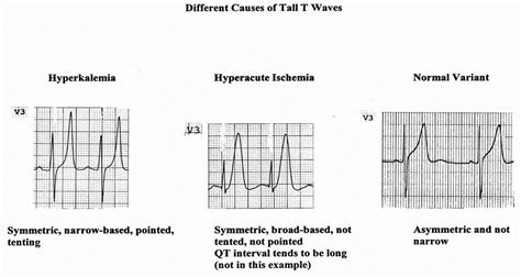 Medical Addicts: Tall T wave on ECG