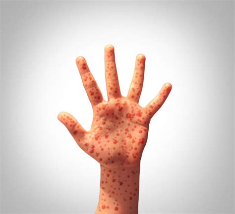 200+ Rubella Rash Stock Photos, Pictures & Royalty-Free Images - iStock