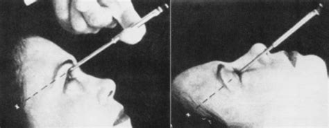 Do you need a lobotomy? Lobotomy Before and After pics | CVLT Nation