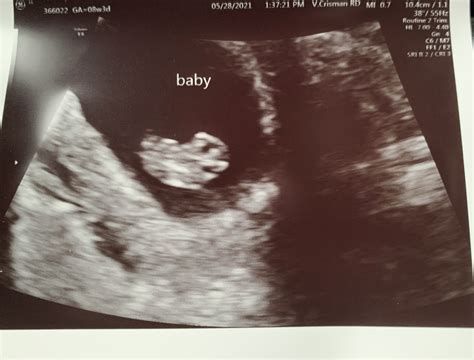 First Ultrasound Was Today! | BabyCenter