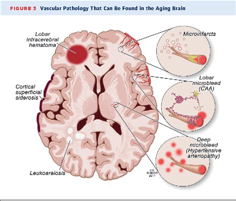 Figure 3 from Cerebral Amyloid Angiopathy: Diagnosis, Clinical ...