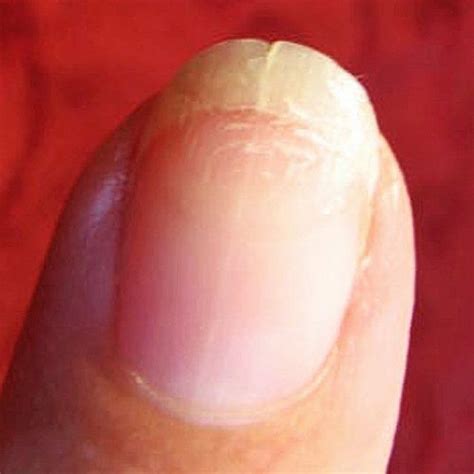 How to Repair Split Nails | Fix broken nail, How to grow nails, Peeling nails