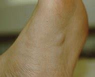 Ledderhose Disease: plantar fibromatosis : Wheeless' Textbook of ...