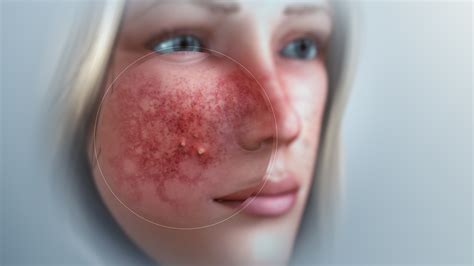 Rosacea: Types, Causes, and Treatment - Scientific Animations