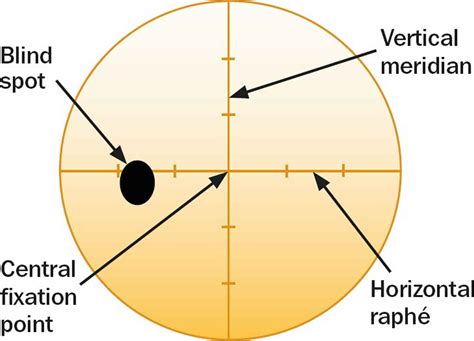 Visual field test, visual field test results interpretation