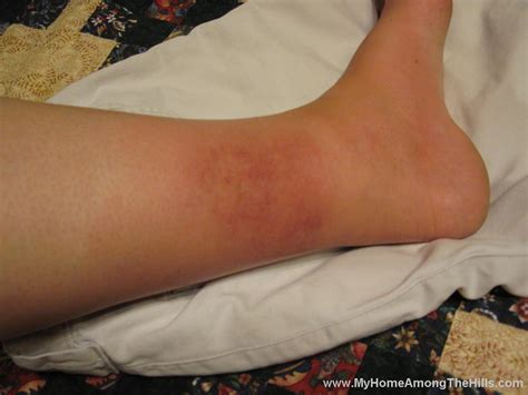 My Wife’s cankle | My Home Among The Hills