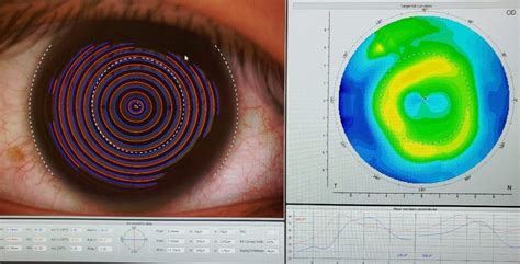 What is Orthokeratology?