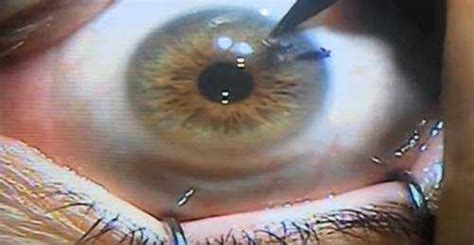 YAG Laser Eye Surgery after Cataract Surgery – EYExan.com