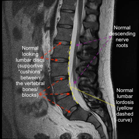 Normal versus abnormal lumbar anatomy | C.N.S. Neurosurgery