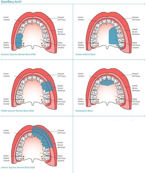 Maxillary Injection Sites | Dental hygiene school, Dental hygiene student, Dental hygienist school