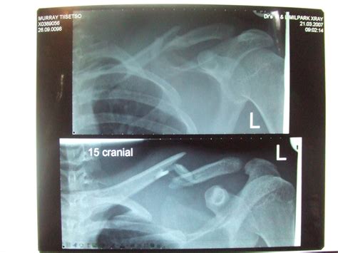Clavicle fracture - wikidoc