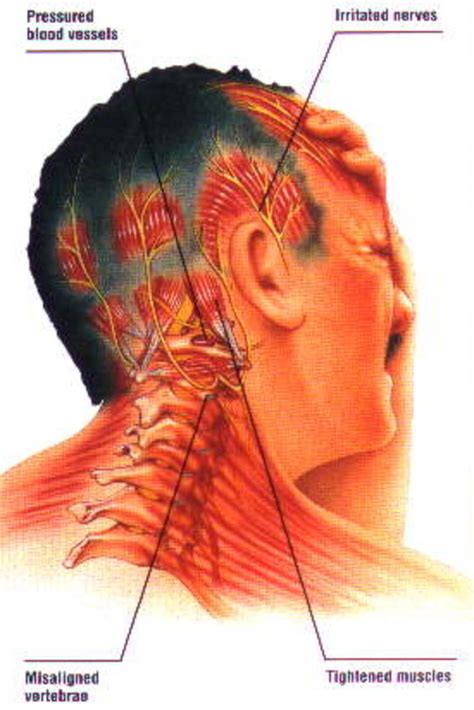 Can Neck and Spine Misalignment Cause Migraines? | HealDove