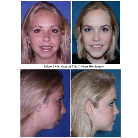 Before and After Photos Maxillofacial Surgery - Larry M. Wolford, DMD