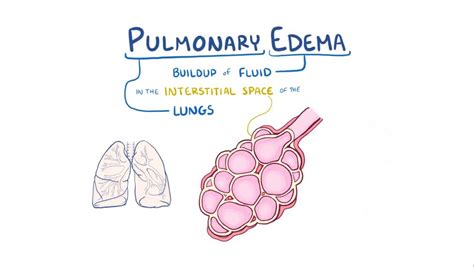 Pulmonary edema: Video, Anatomy, Definition & Function | Osmosis