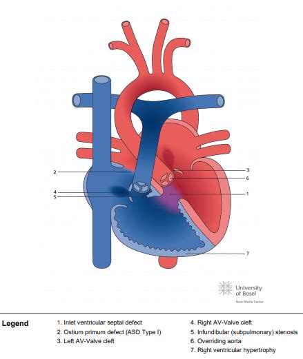 Complete atrioventricular septal defect (AVSD) with tetralogy of Fallot - Perfusfind