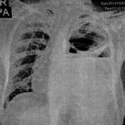Chest radiograph before laparatomy and chest tube drainage revealing... | Download Scientific ...