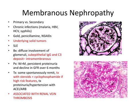 Membranous Nephropathy Histology