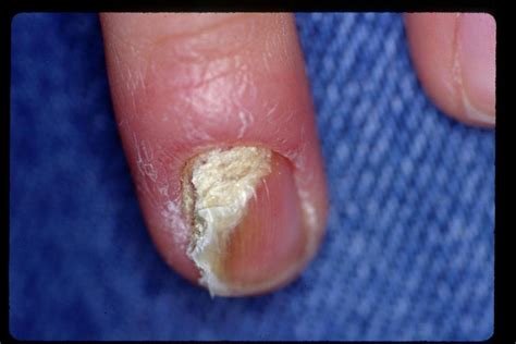 Subungual Hyperkeratosis