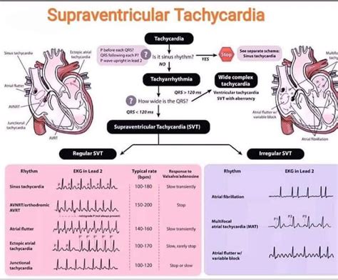 Approach to Supraventricular Tachycardia - SVT