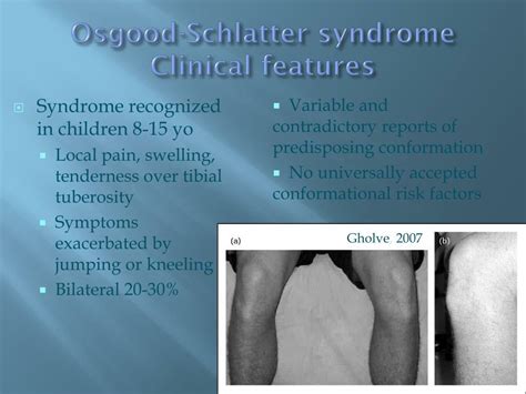 PPT - Osgood- schlatter syndrome PowerPoint Presentation, free download - ID:2176665