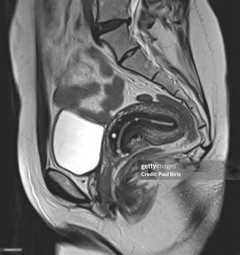 Uterus Anatomy Mri