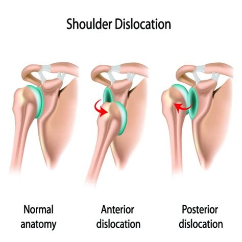 Shoulder Dislocation Treatment in Bangalore | Shoulder Surgery India