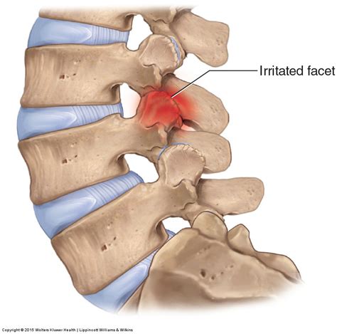 Facet Syndrome of the Lumbar Spine