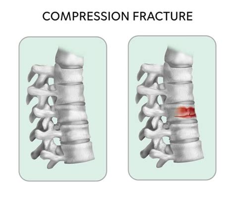 Compression Fractures - SpineCare Singapore