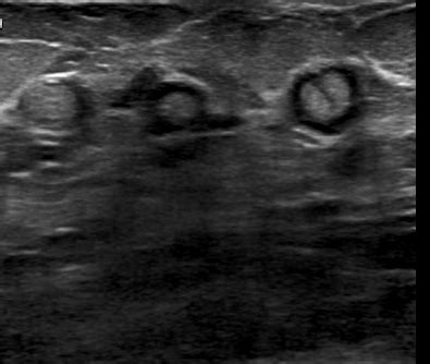 Duct ectasia with inspissated secretions | Image | Radiopaedia.org