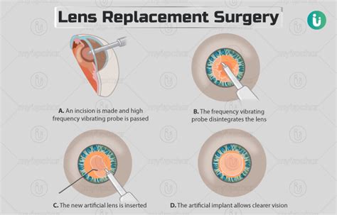 Lens replacement surgery: Procedure, Purpose, Results, Cost, Price