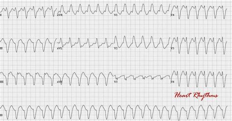 ECG Rhythms: Wide QRS Tachycardia