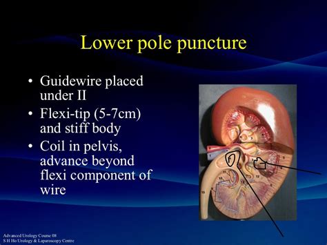 PCNL - the Perfect Puncture