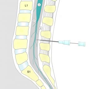 Difference Between Spinal and Epidural Anesthesia | Purpose, Procedure, Effect, Risks