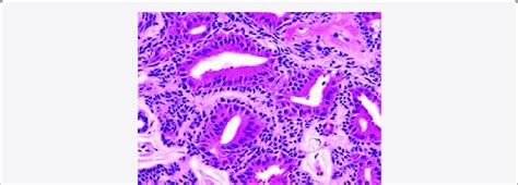 Ceruminous adenoma delineating glandular structures lined by dual... | Download Scientific Diagram