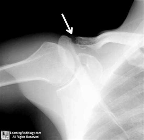 50k-shoulder injury: Learning Radiology- clavicle, clavicular ...