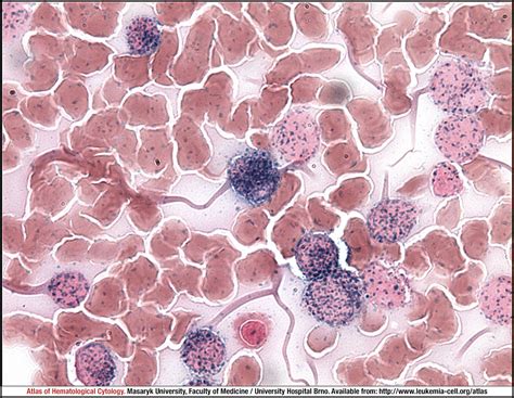 Acute monoblastic/monocytic leukaemia - CELL - Atlas of Haematological Cytology