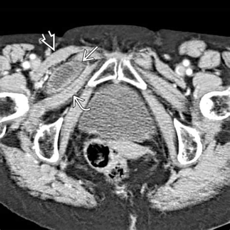 Obturator Hernia | Radiology Key