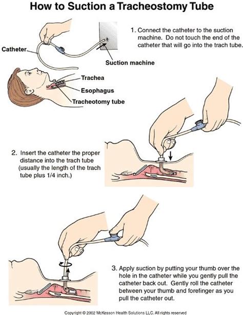 Pin by Leslee Usimaki on Nursing | Nursing care, Tracheostomy care ...