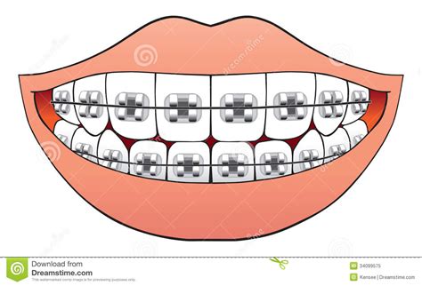 Braces clipart 20 free Cliparts | Download images on Clipground 2024