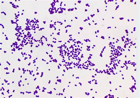 Streptococcus pyogenes en citologia