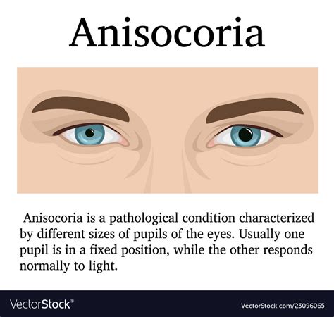 Anisocoria Royalty Free Vector Image - VectorStock