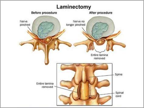 Laminectomy Procedure and Recovery | Disectomy Surgery in Bangalore, India