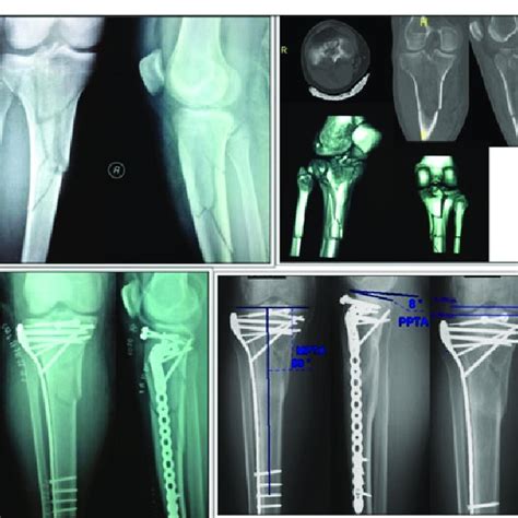 Schatzker V fracture. Top Left: Preoperative A-P & lateral radiographs ...