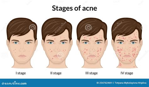 Stages Of Acne Formation In The Human Skin Cartoon Vector ...