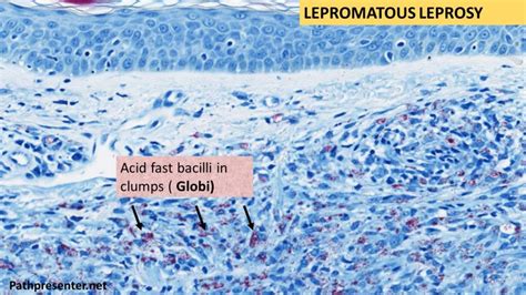 LEPROSY- Tuberculoid & Lepromatous - Pathology Made Simple